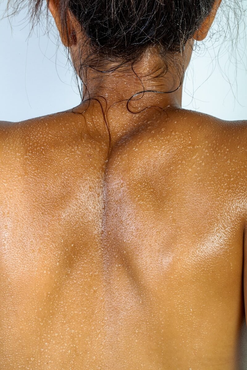 Keratosis Pilaris